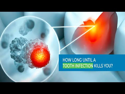 How Long Until a Tooth Infection Kills You? | Understanding the Risks and Prevention