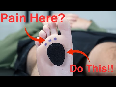 Metatarsal Pad (Correct Placement)