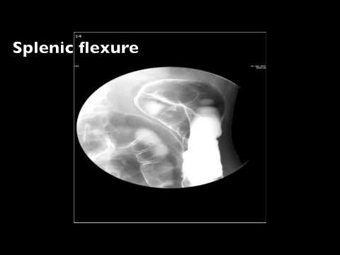 Barium Enema Double Contrast Fluoro --- Step by Step Instructions