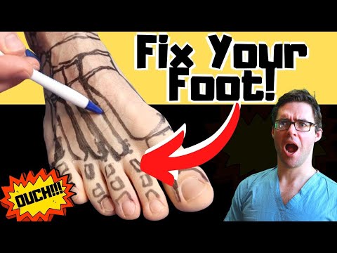 Broken Foot Recovery & Foot Fracture Home Treatments [Top 25 Hacks]