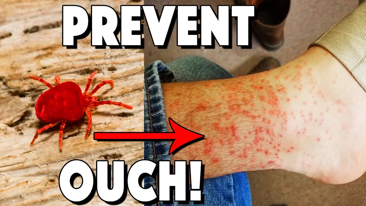 What Are Chiggers, How To Treat Bites, And How To Prevent!