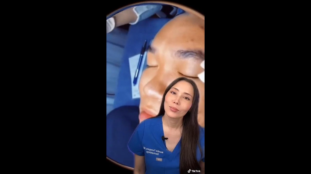 Blackhead removal