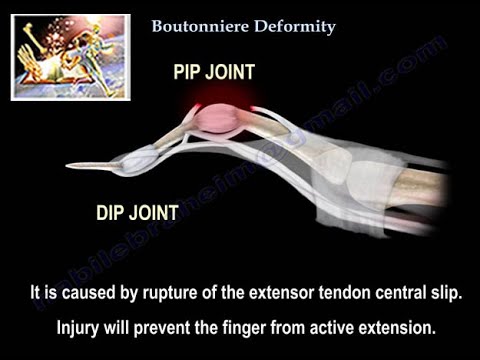Boutonniere Deformity - Everything You Need To Know - Dr. Nabil Ebraheim