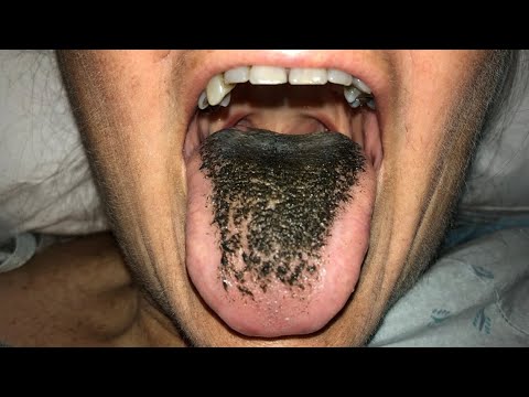 BLACK HAIRY TONGUE?! How To Get Rid Of It 👅