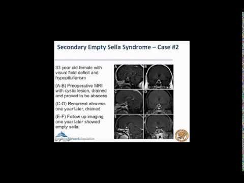 Empty Sella Syndrome