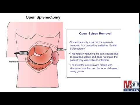 Splenectomy