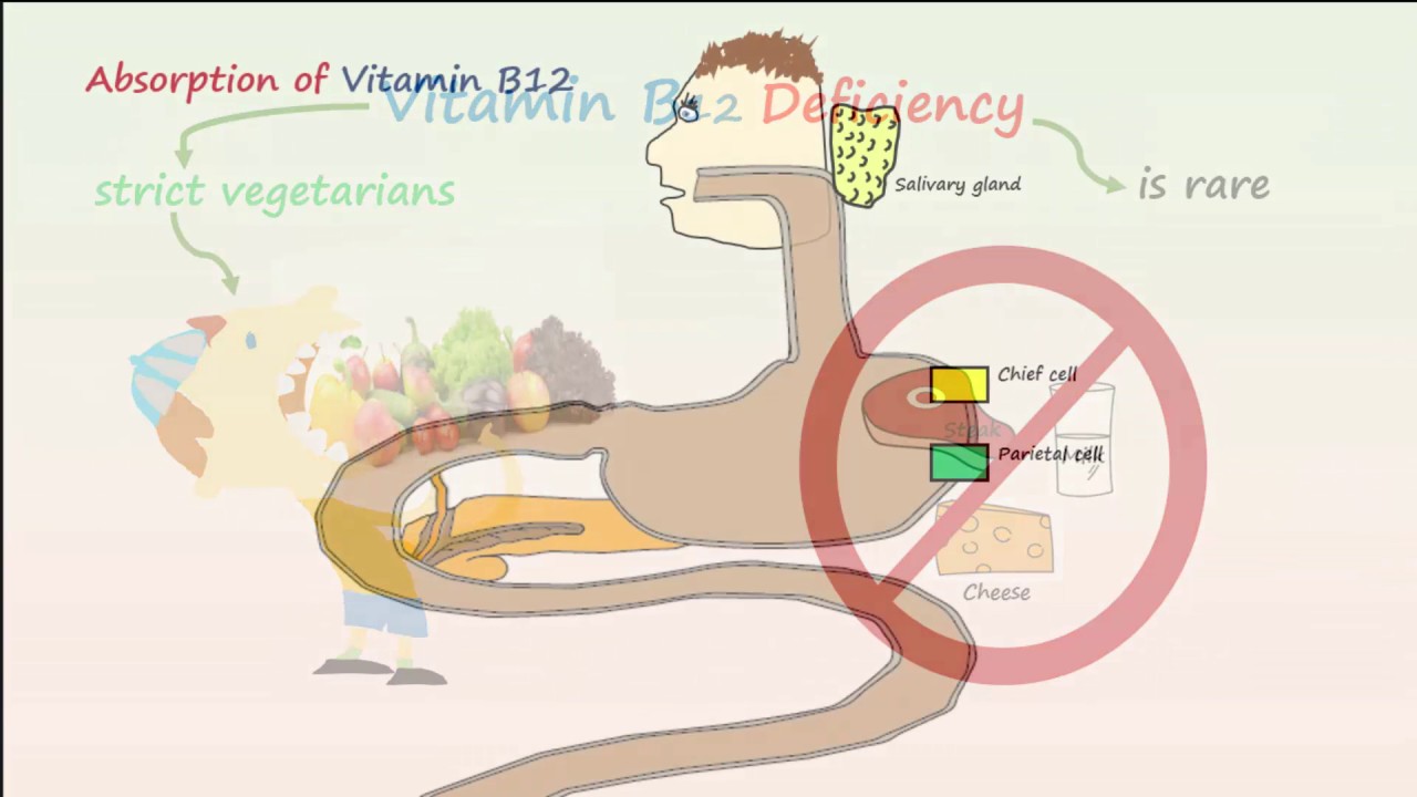 Megaloblastic Anemia Part 1- Vitamin B12 Deficiency Anemia