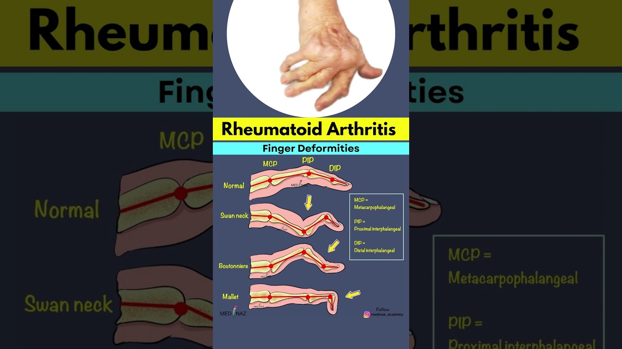 Rheumatoid Arthritis Finger Deformities Explained | Swan Neck, Boutonniere & Mallet Finger