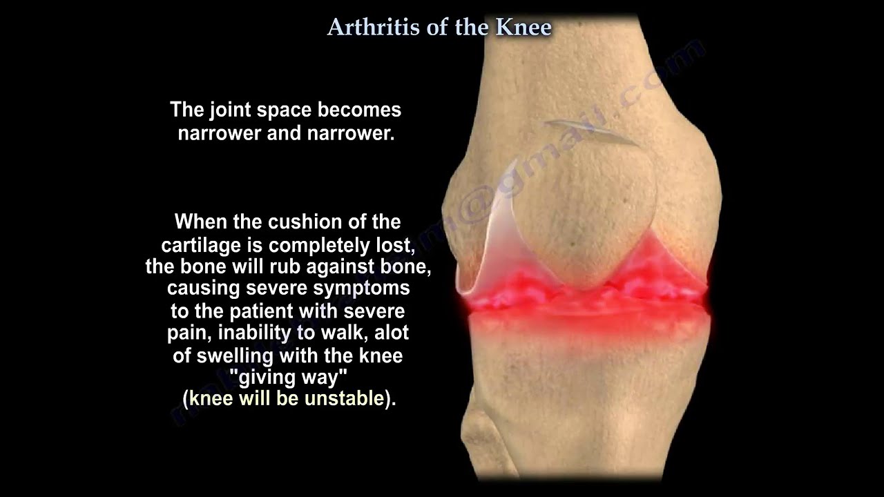 Knee arthritis symptoms and treatment - Everything You Need To Know - Dr. Nabil Ebraheim