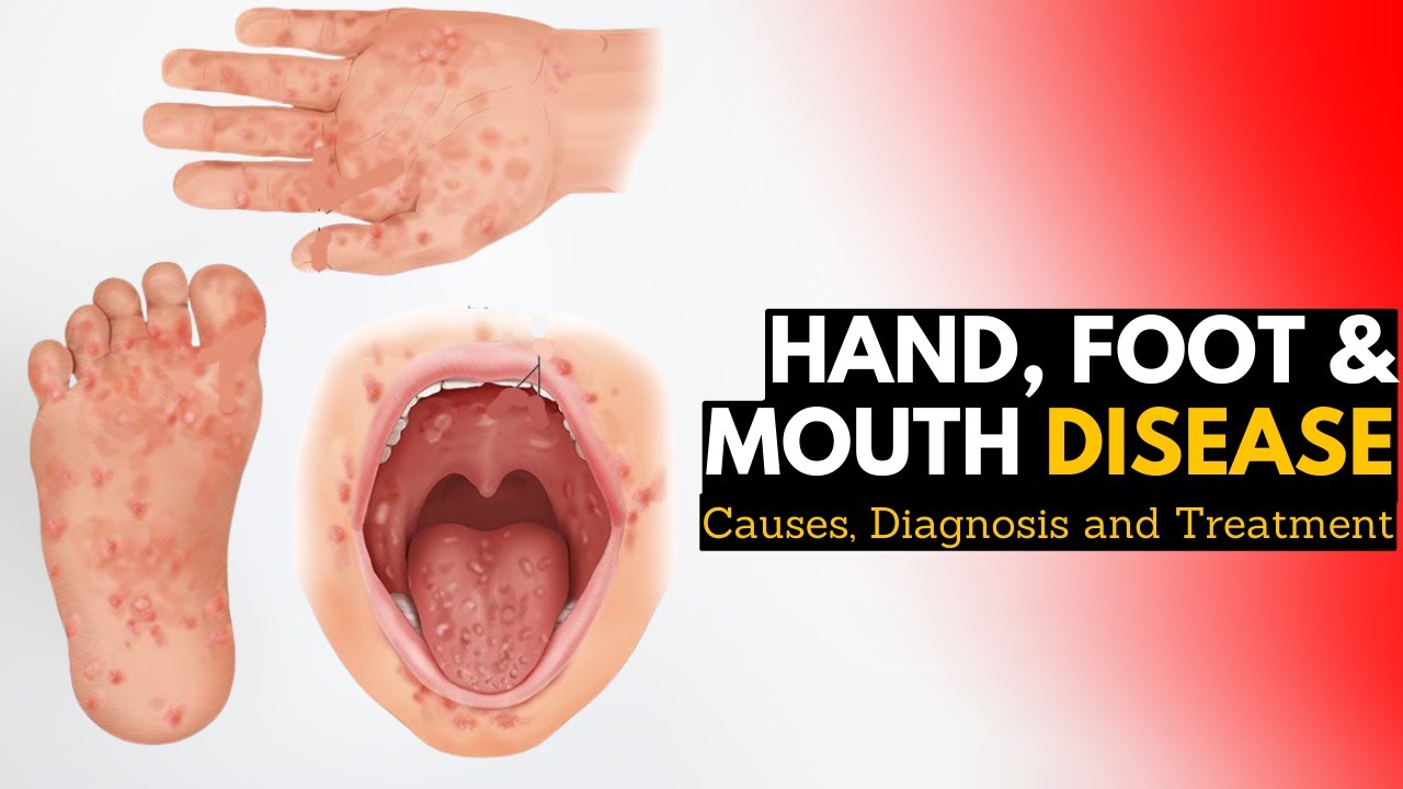 Hand, Foot, and Mouth Disease, Causes, Signs and Symptoms, Diagnosis and Treatment,