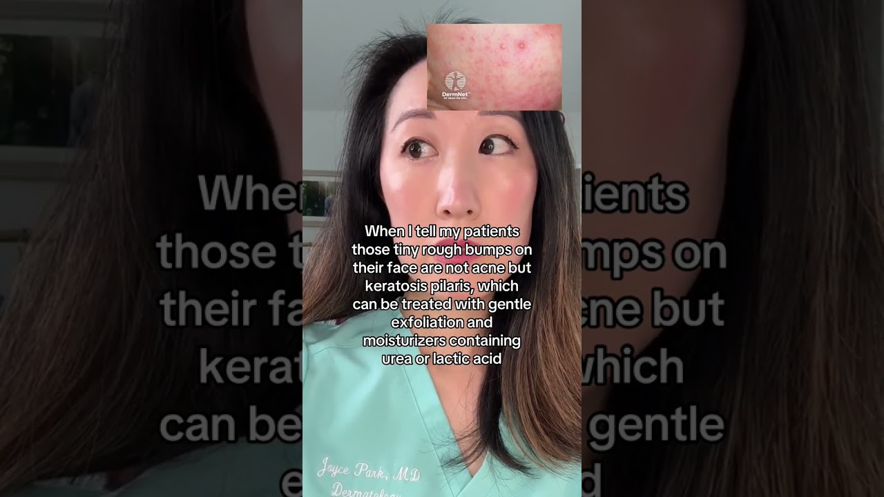 Those Tiny Bumps on Your Face? It’s KP, Not Acne – Here’s What to Do
