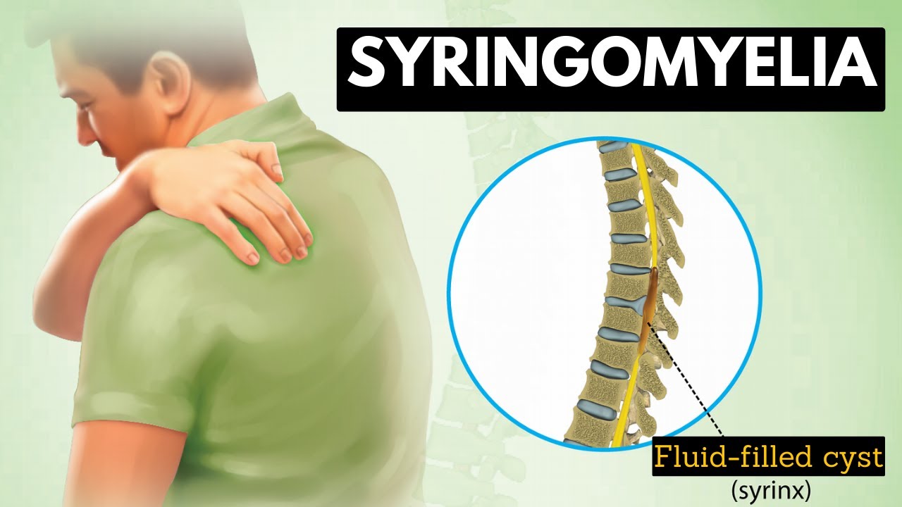Syringomyelia: Everything You Need To Know