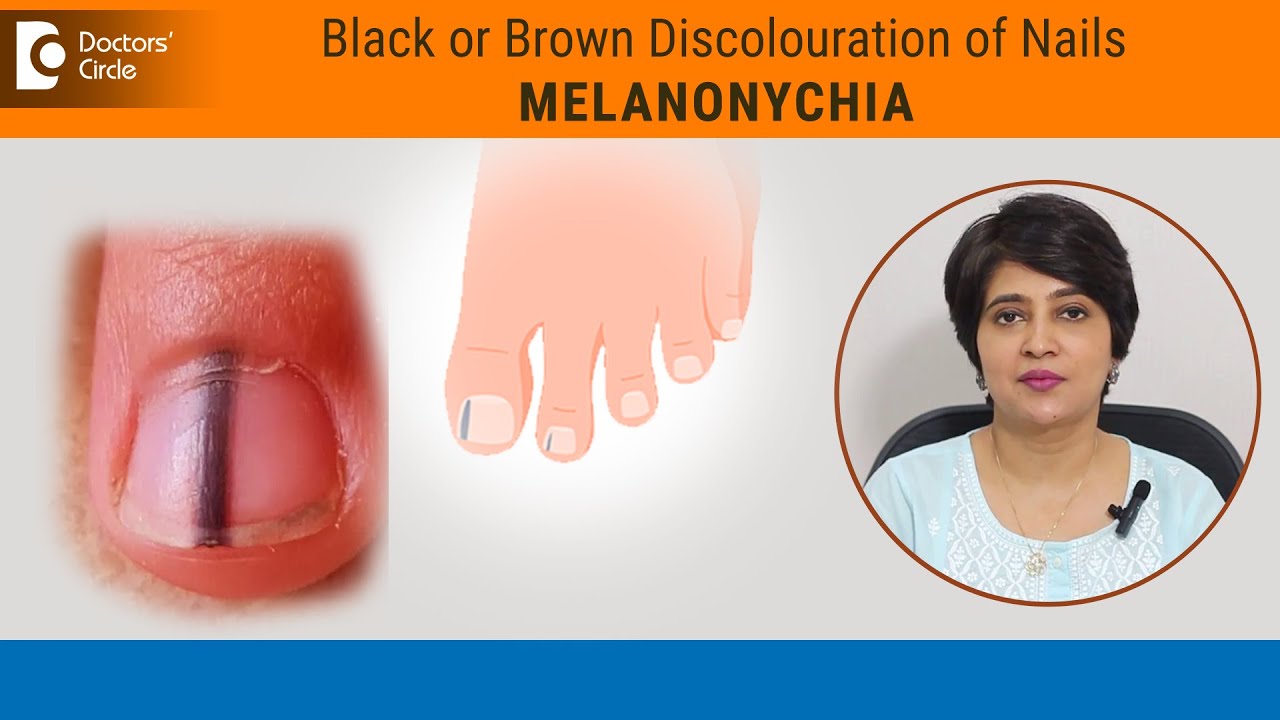 Black lines in nails| Streaks on Nail|Melanonychia Causes & Treatment-Dr.Rasya Dixit|Doctors' Circle