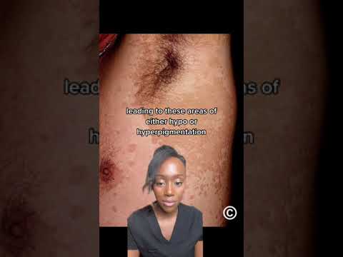 Fungal Rash? Or Something Else? A Deep Dive into Pityriasis Versicolor!