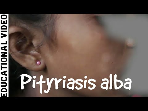 Dermatology | Case Discussion | Pityriasis alba | Dr. Suchana Marahatta