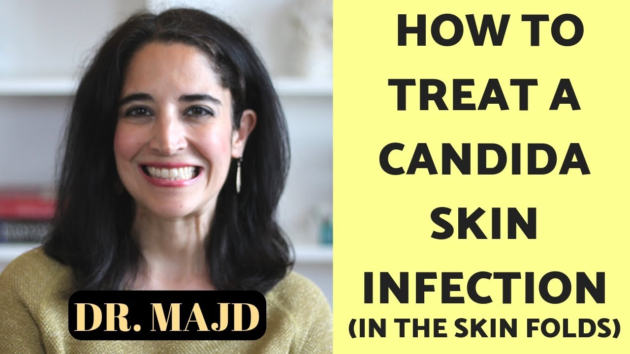 Treatment of Fungus in the Folds