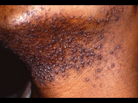 PSEUDOFOLLICULITIS BARBAE (Razor Bumps) Symptoms, Causes, Treatment
