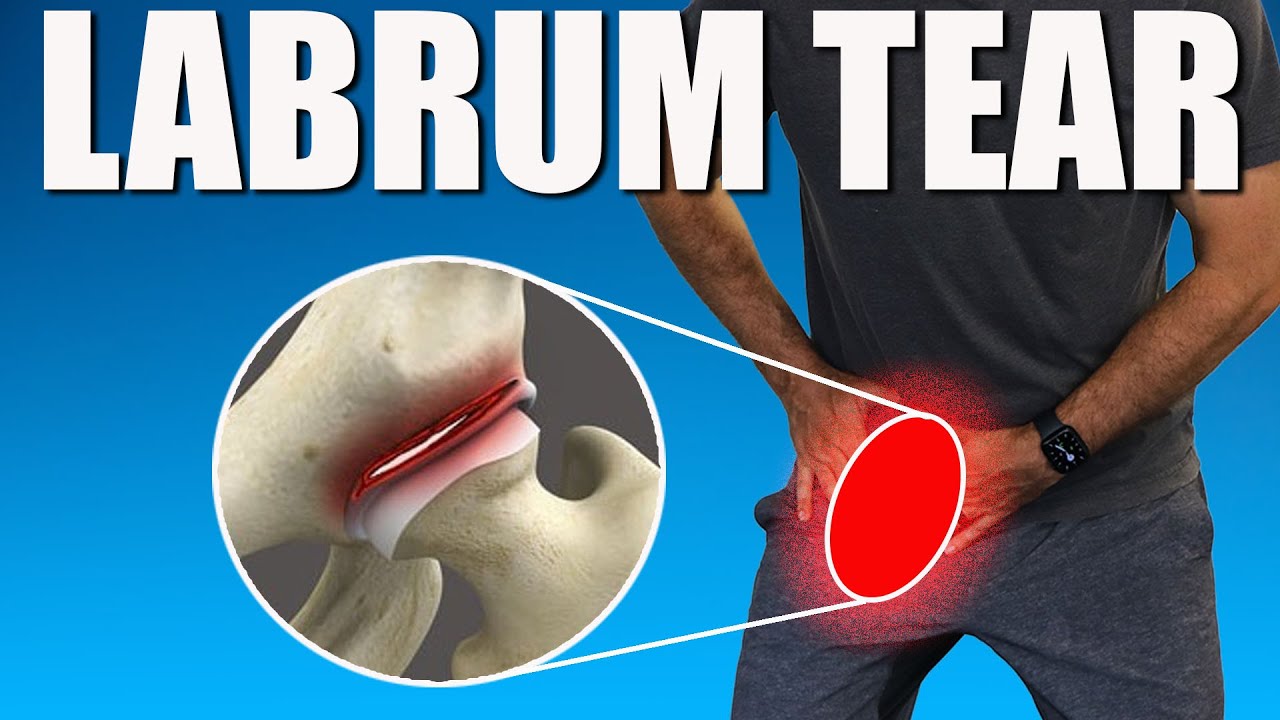 HIP LABRUM TEAR.  BEST Exercises, Stretches & Advice for Hip & Groin Pain Relief