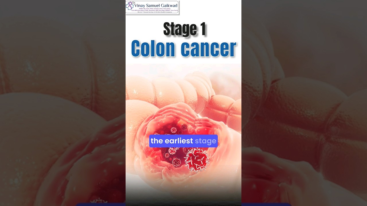 Stage 1 Colon Cancer(What You Should Know) #coloncancer