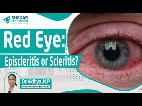 Episcleritis and Scleritis: Symptoms, Treatments, Causes | Shekar Eye Hospital