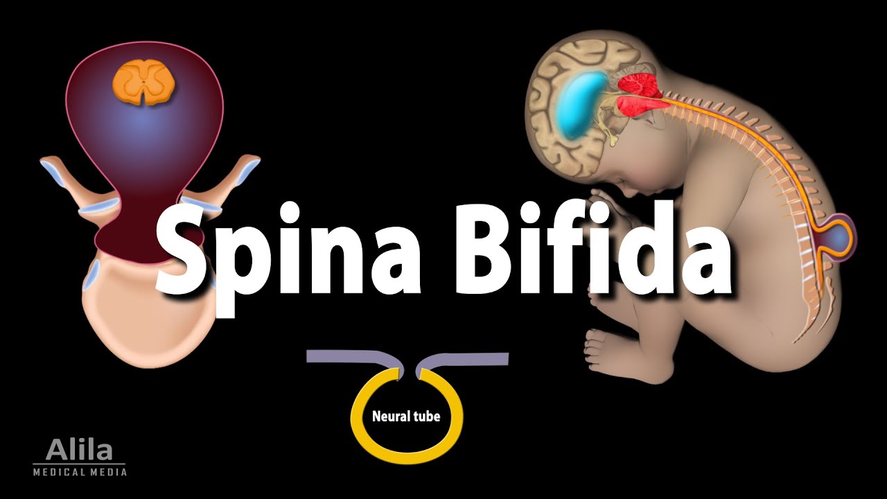 Spina Bifida, Animation