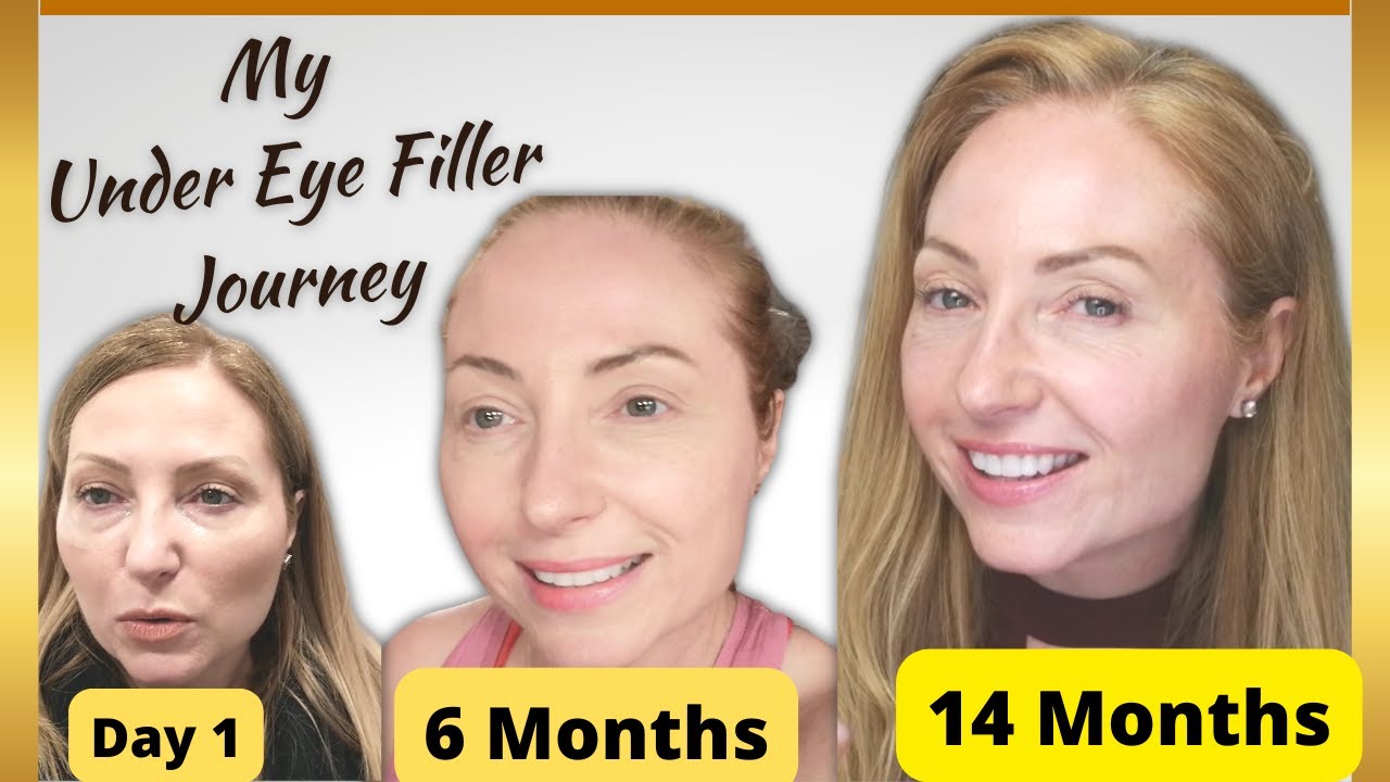 Under Eye Filler Journey | Before & After | Day 1 to Present
