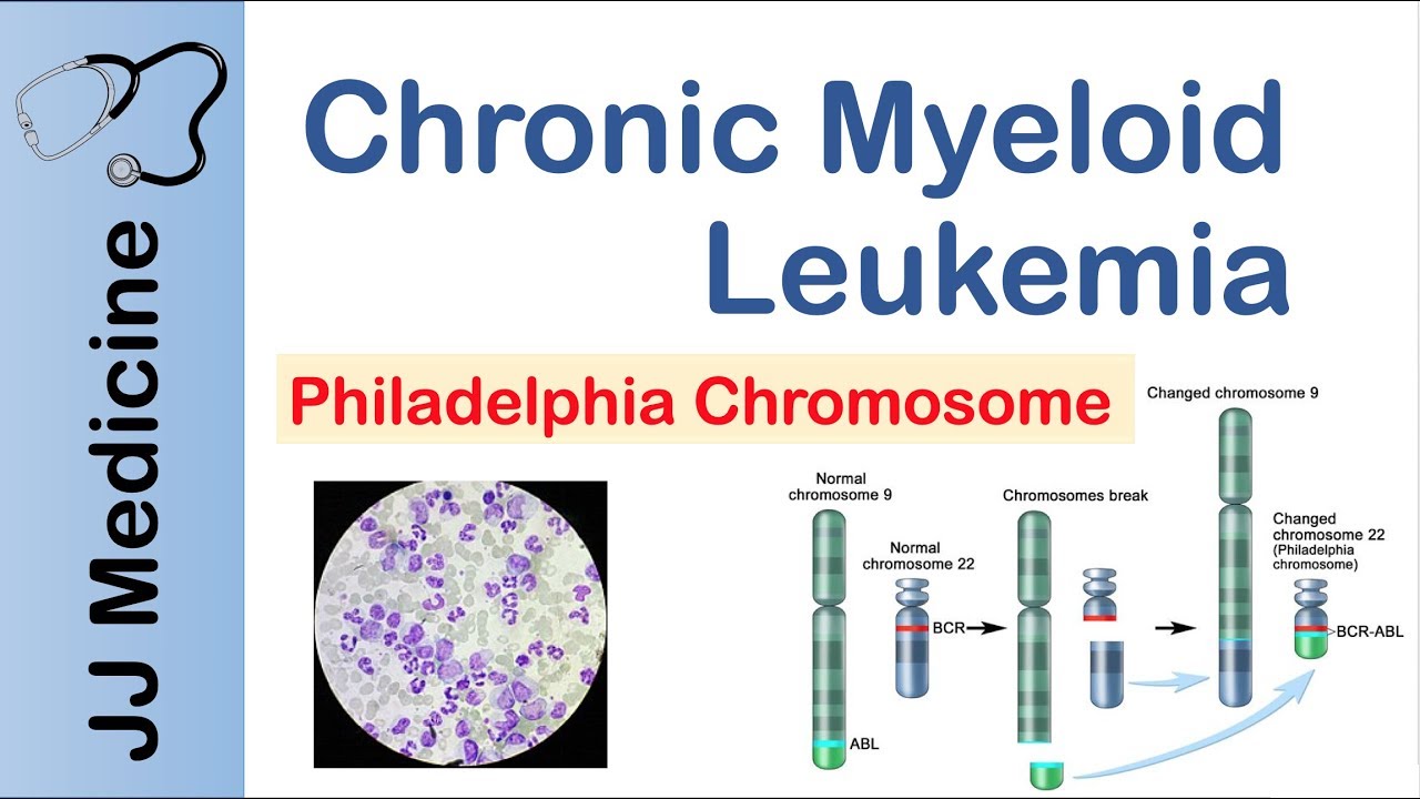 Chronic Myeloid Leukemia (CML) | Pathogenesis, Symptoms and Treatment