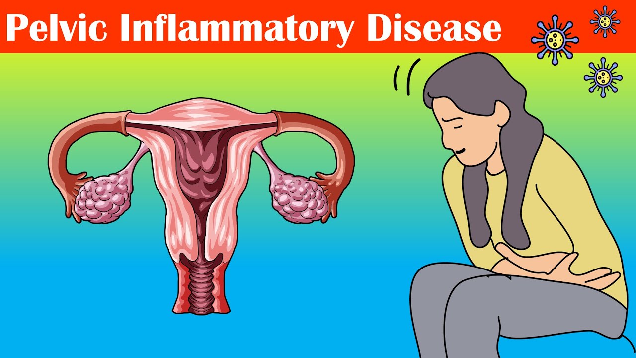 Pelvic Inflammatory Disease (PID) - Causes, Signs & Symptoms, Diagnosis, And Treatment