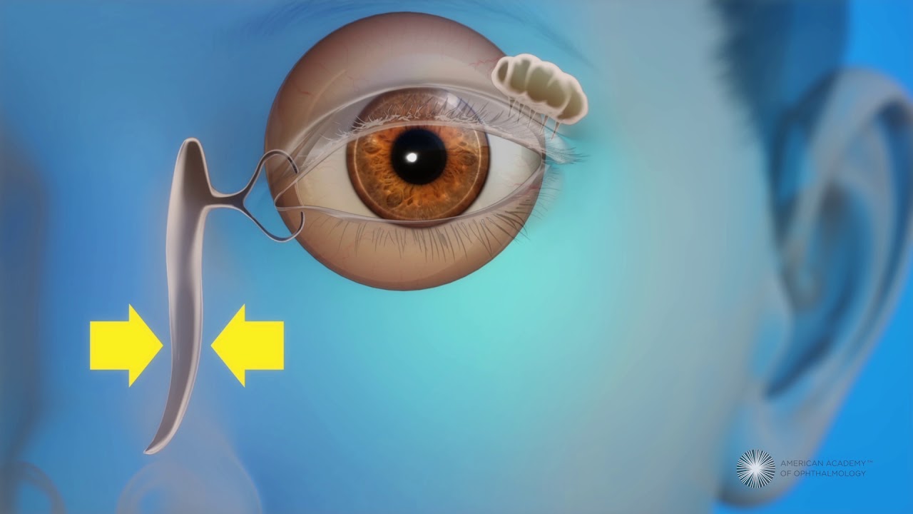 What is a blocked tear duct?