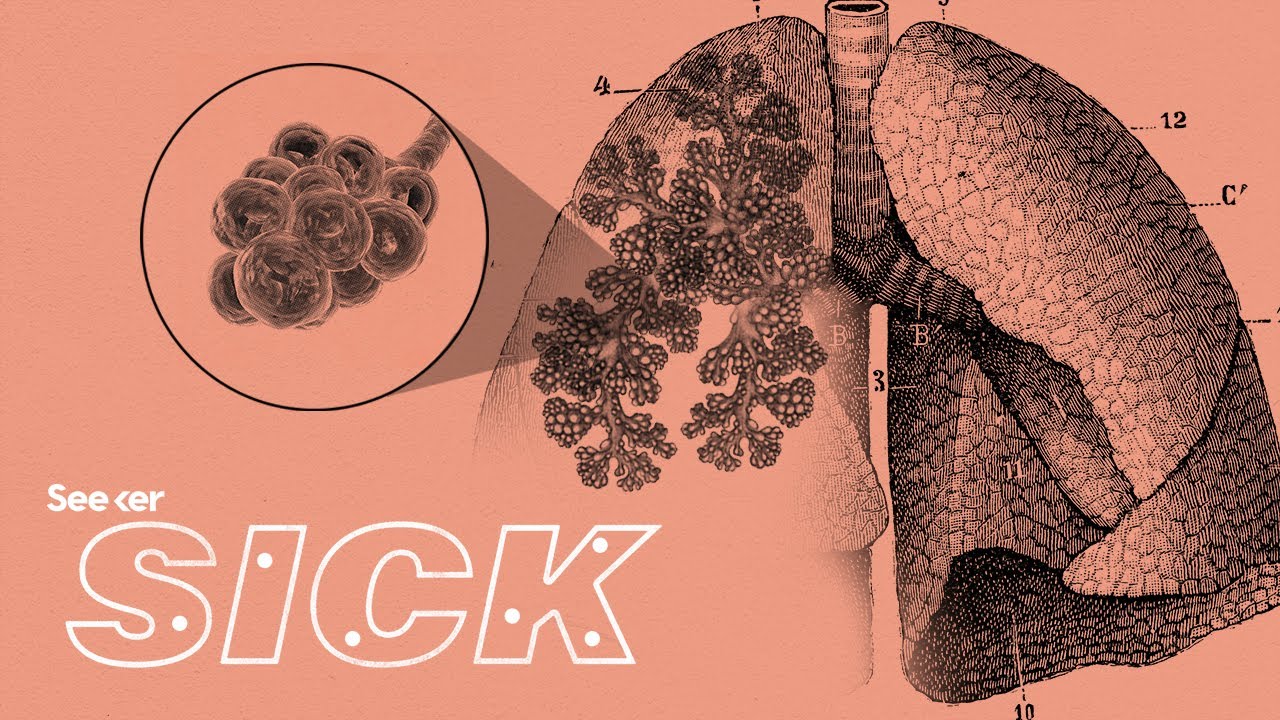 Here's Why Pneumonia Is Still So Deadly