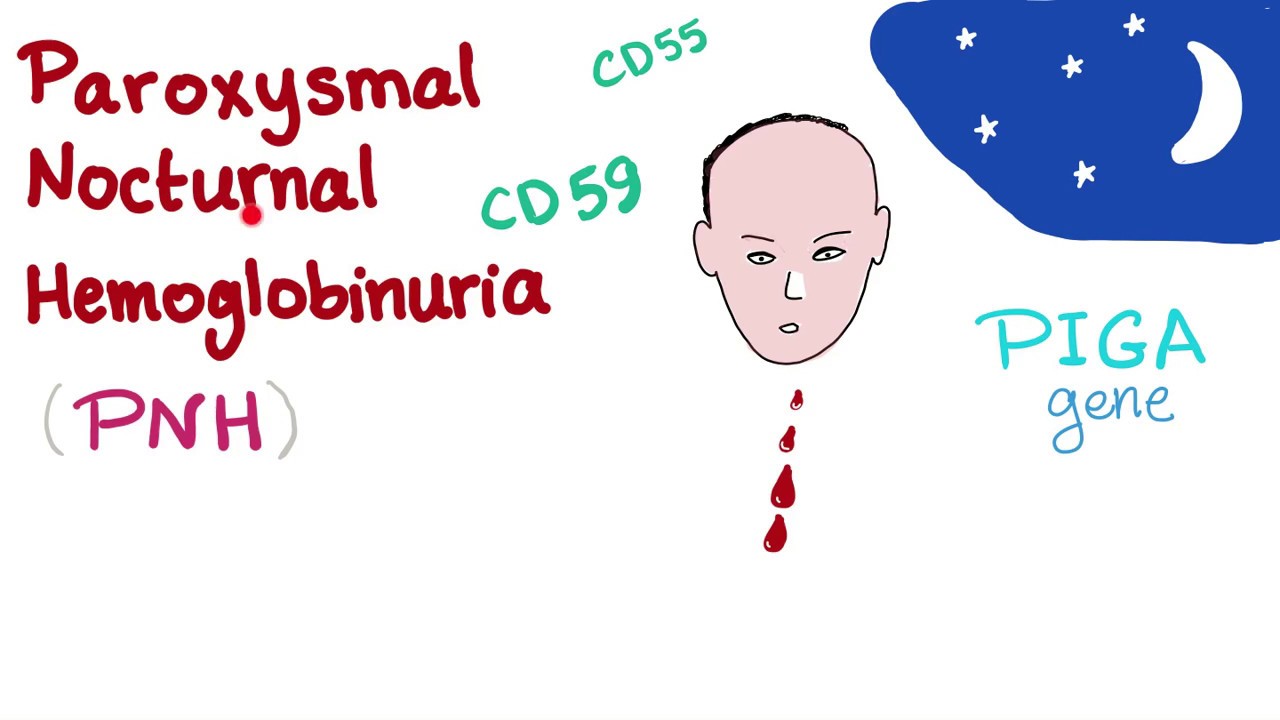 Paroxysmal Nocturnal Hemoglobinuria (PNH) - Hemolytic Anemia - Complement Alternative Pathway