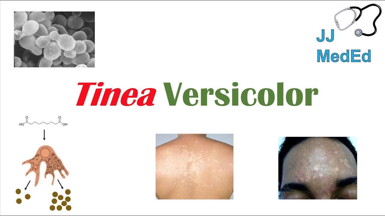 “Fungal Skin Infection of Many Colors” (Tinea Versicolor) | Pathogenesis, Symptoms and Treatment