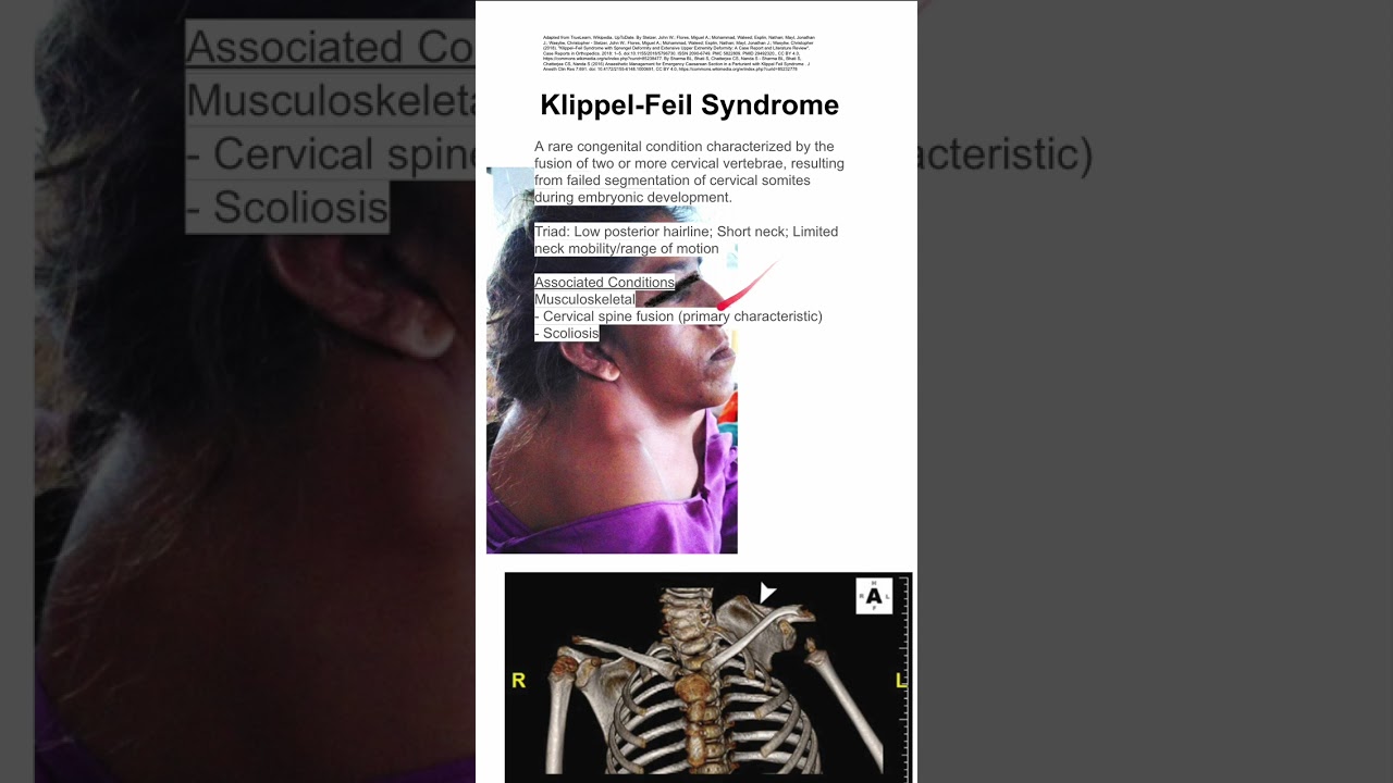 Klippel-Feil Syndrome