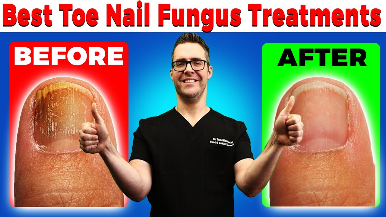 Best Toe Nail Fungus Treatments [Onychomycosis Remedies]
