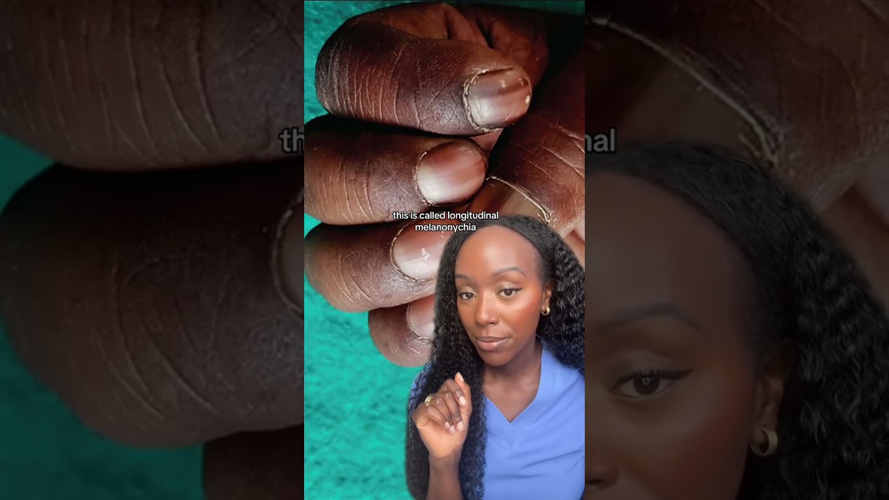 Kai Cenat Has A Rare Nail Condition (Longitudinal melanonychia)