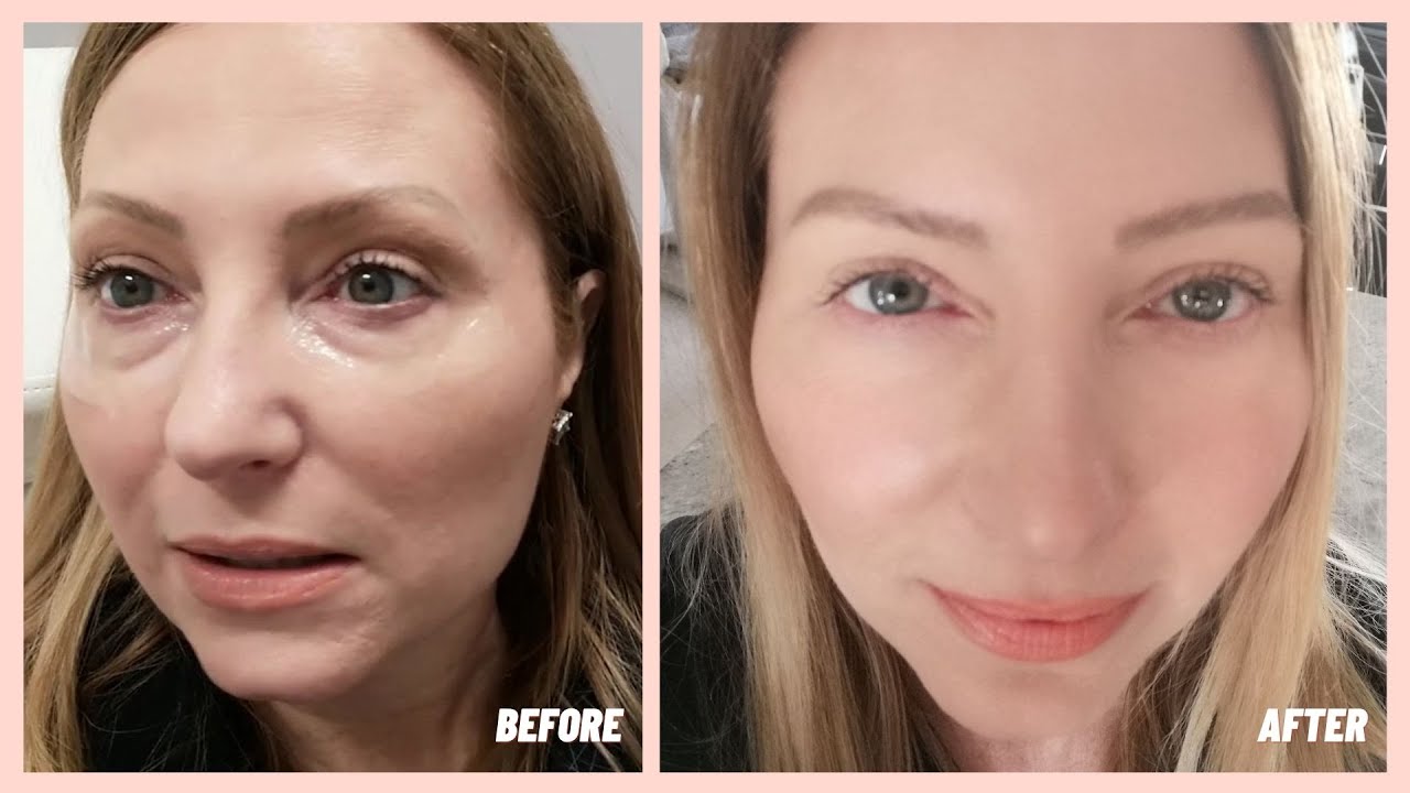 Under Eye Filler | Before & After | My Experience