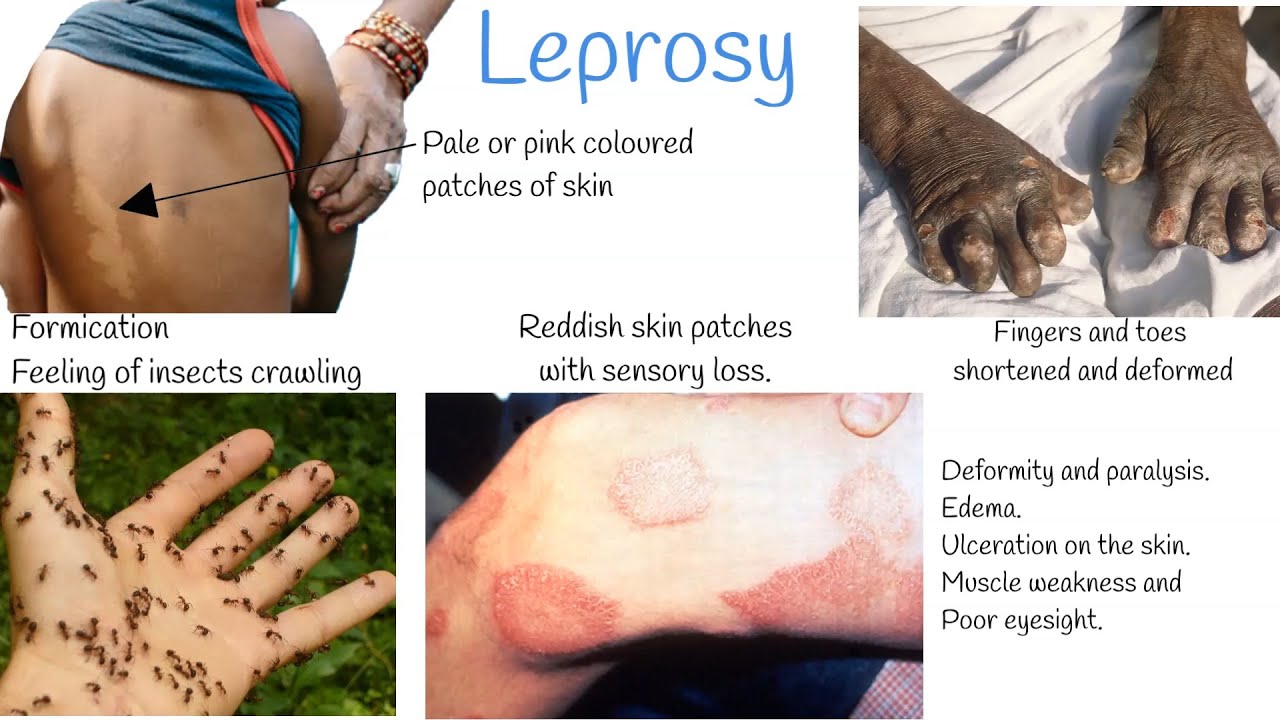 Leprosy signs and symptoms, Treatment. (Hansen's Disease)