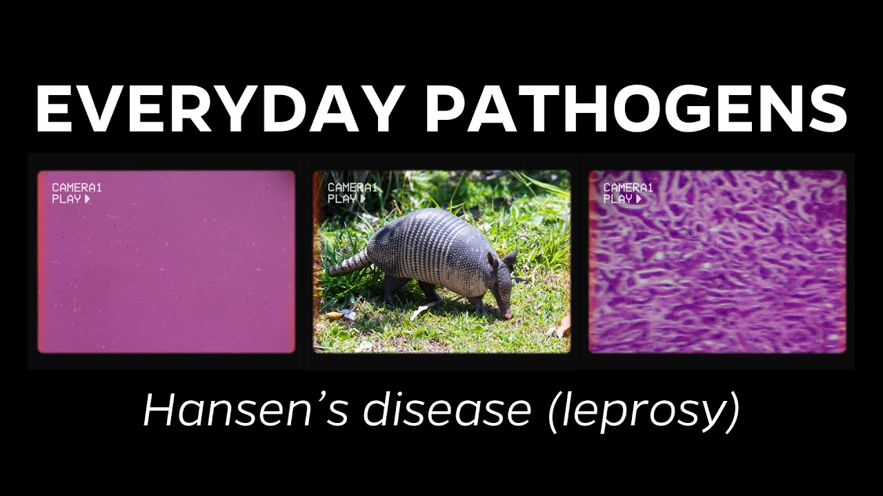 What is leprosy (a.k.a. Hansen's disease)?