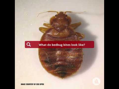 What Do Bedbug Bites Look Like?