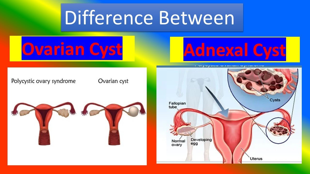 Difference Between Ovarian cyst and Adnexal Cyst