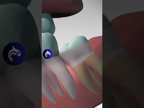 Wisdom Teeth: See Why and How They're Removed #wisdomteeth #teeth #oralhealth