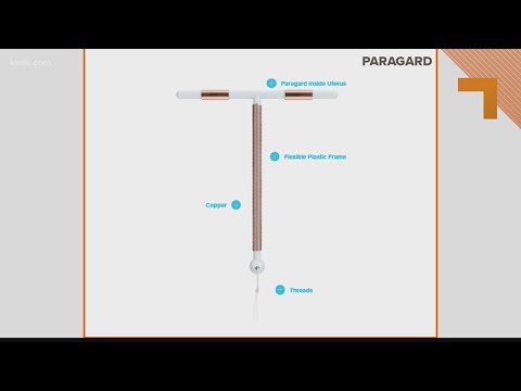 What you should know about the IUD Paragard