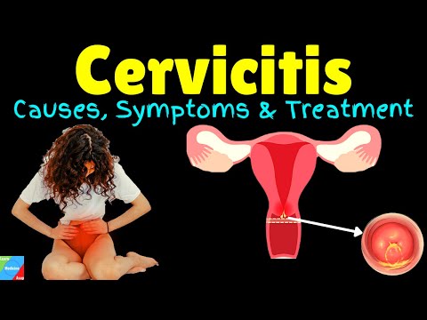 Cervicitis – Symptoms, Causes, Diagnosis, Treatment, Complications, Prognosis