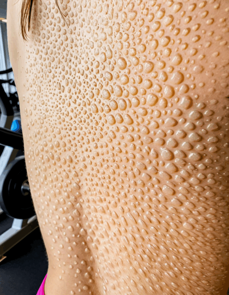 tiny colorless itchy bumps on skin