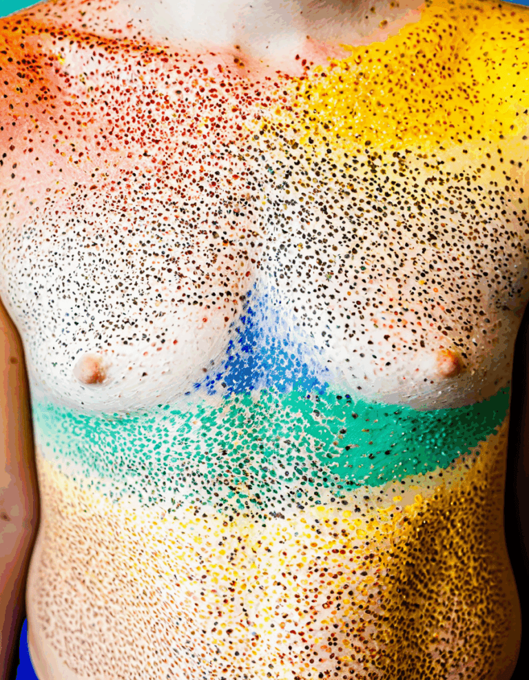 pityriasis versicolor